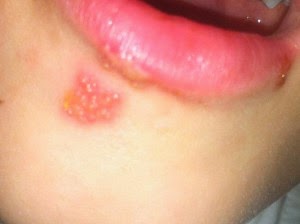 Remedios caseros para curar rapidamente herpes labial